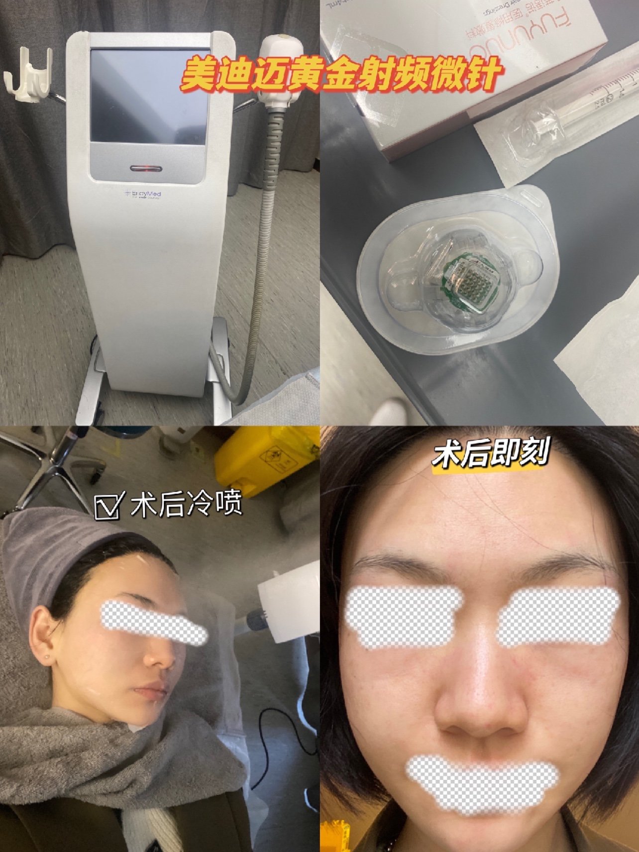 endymed美迪迈黄金射频微针恢复期记录