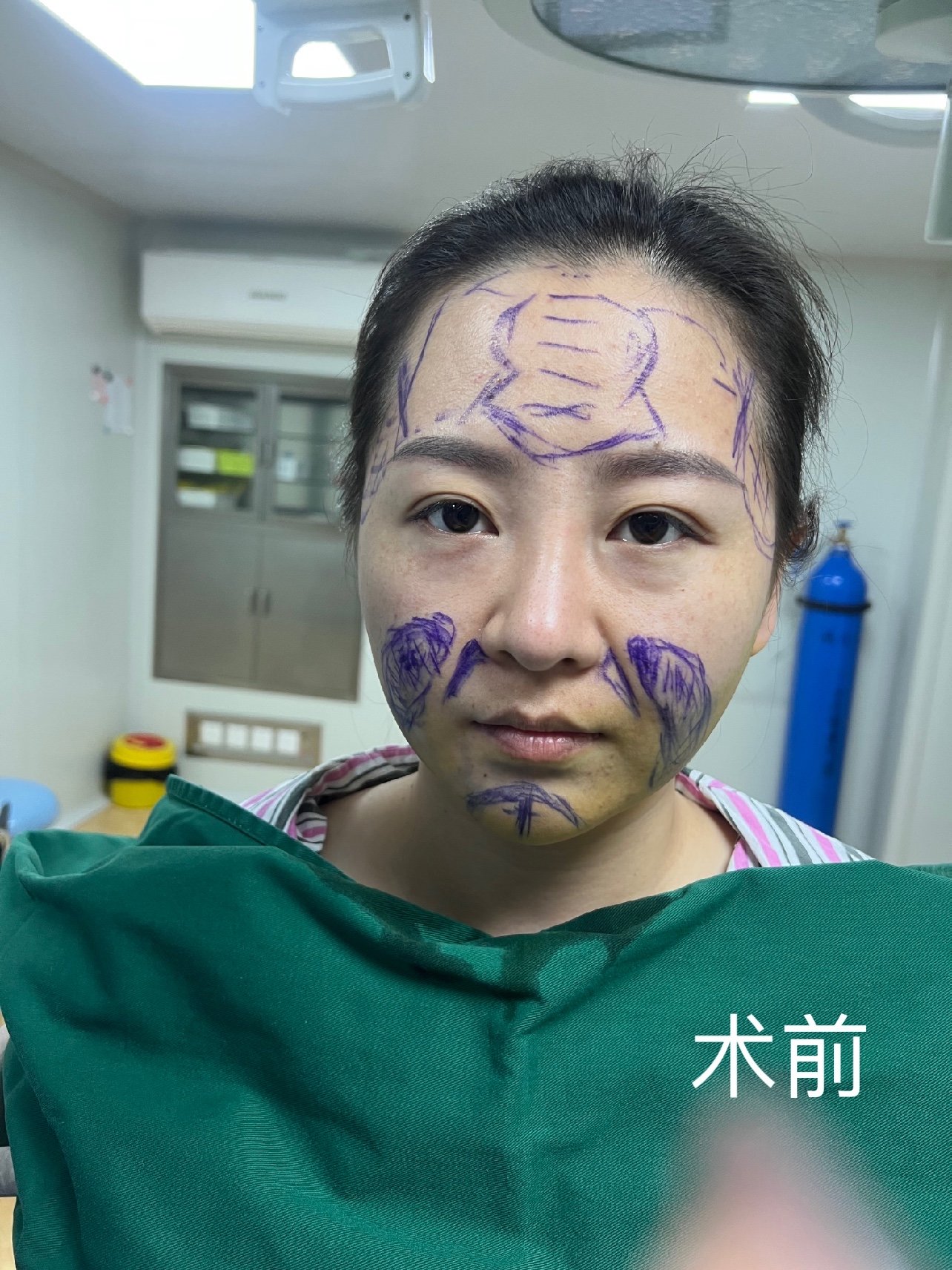 自体脂肪填充额头 太阳穴 法令纹 下巴 面部吸脂 _圈子-新氧美容整形