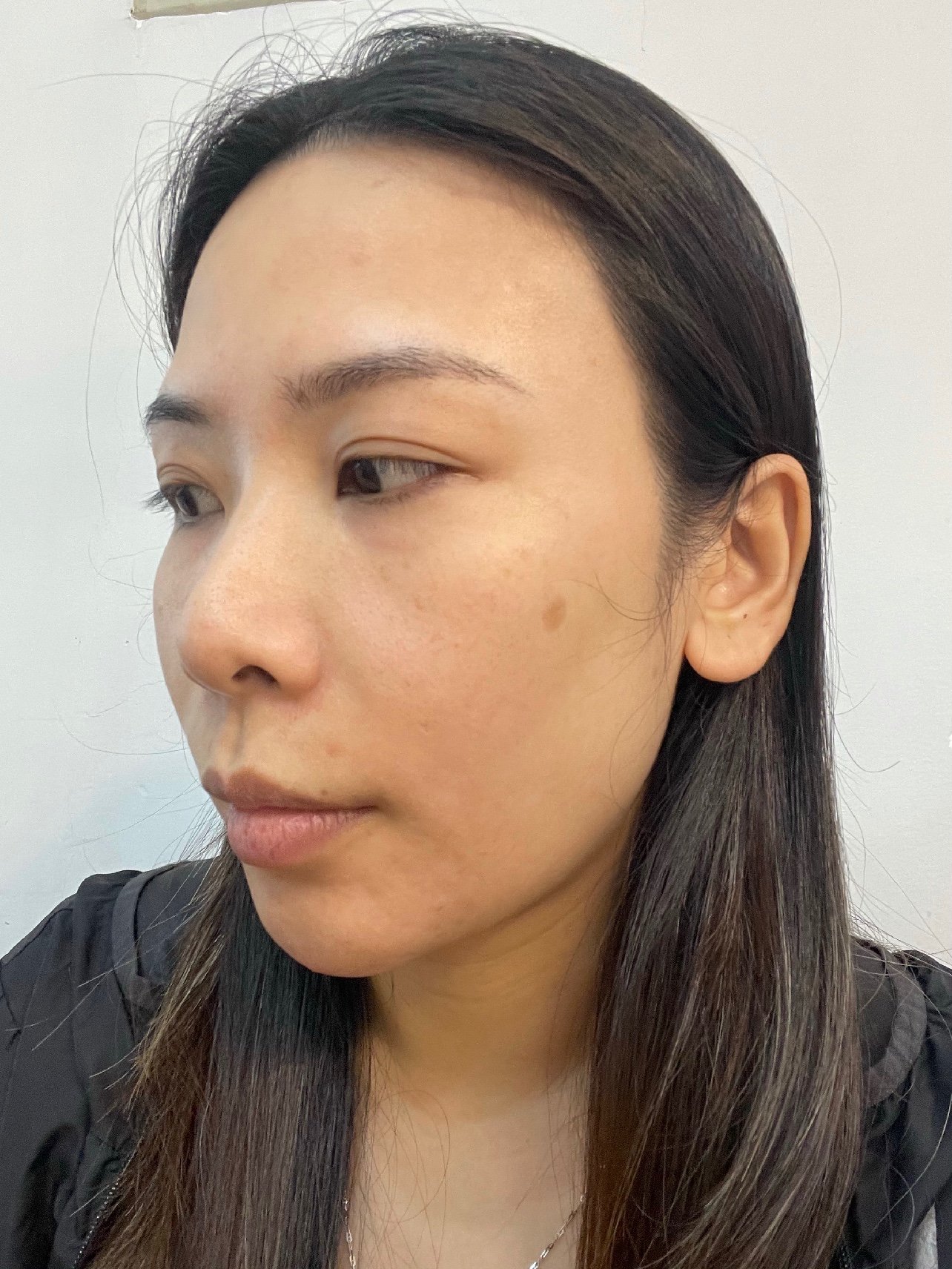 鼻基底凹陷是我一直比较烦恼的问题高度适中的鼻基底可以增加面部的