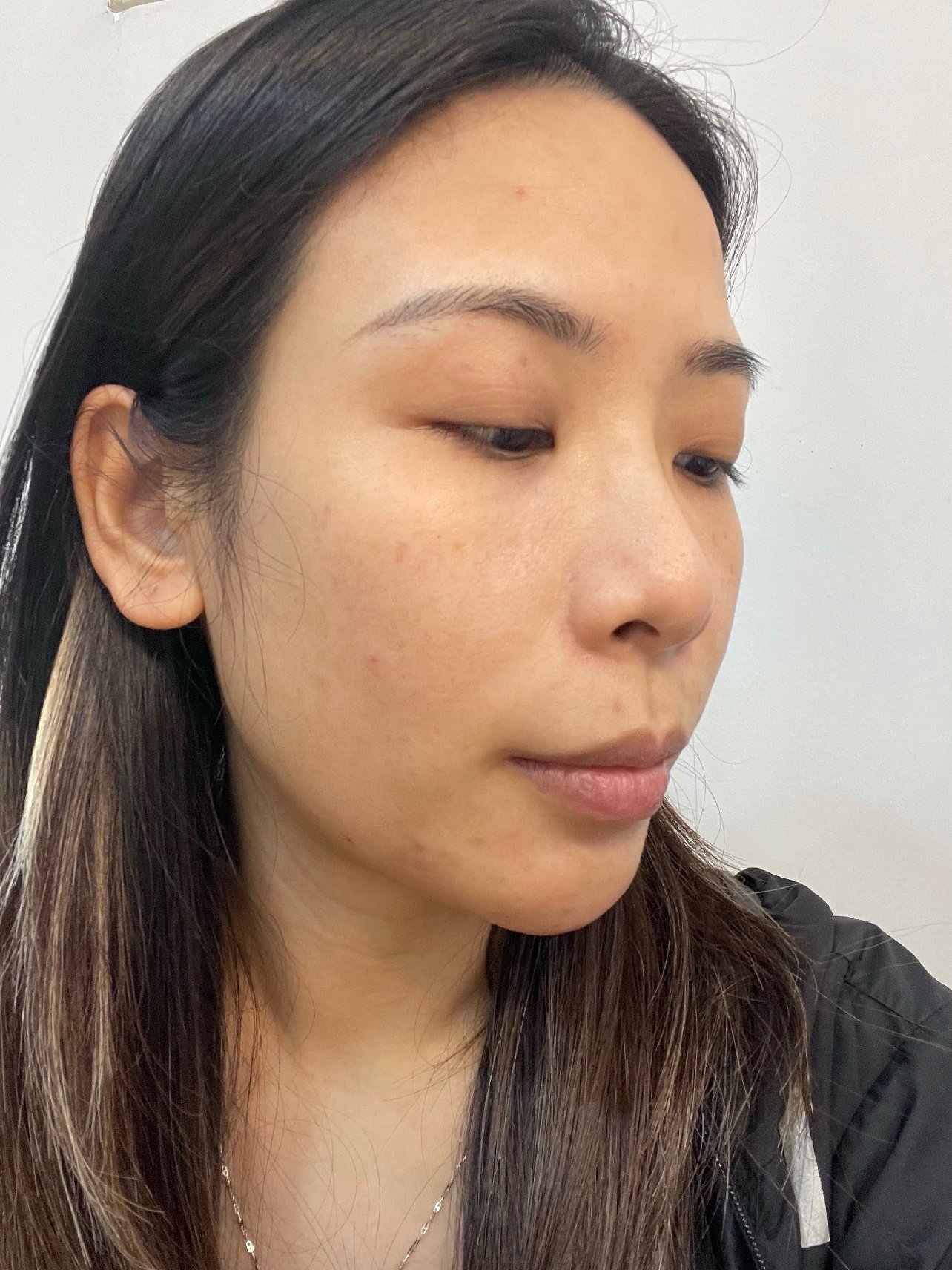 鼻基底凹陷是我一直比较烦恼的问题高度适中的鼻基底可以增加面部的