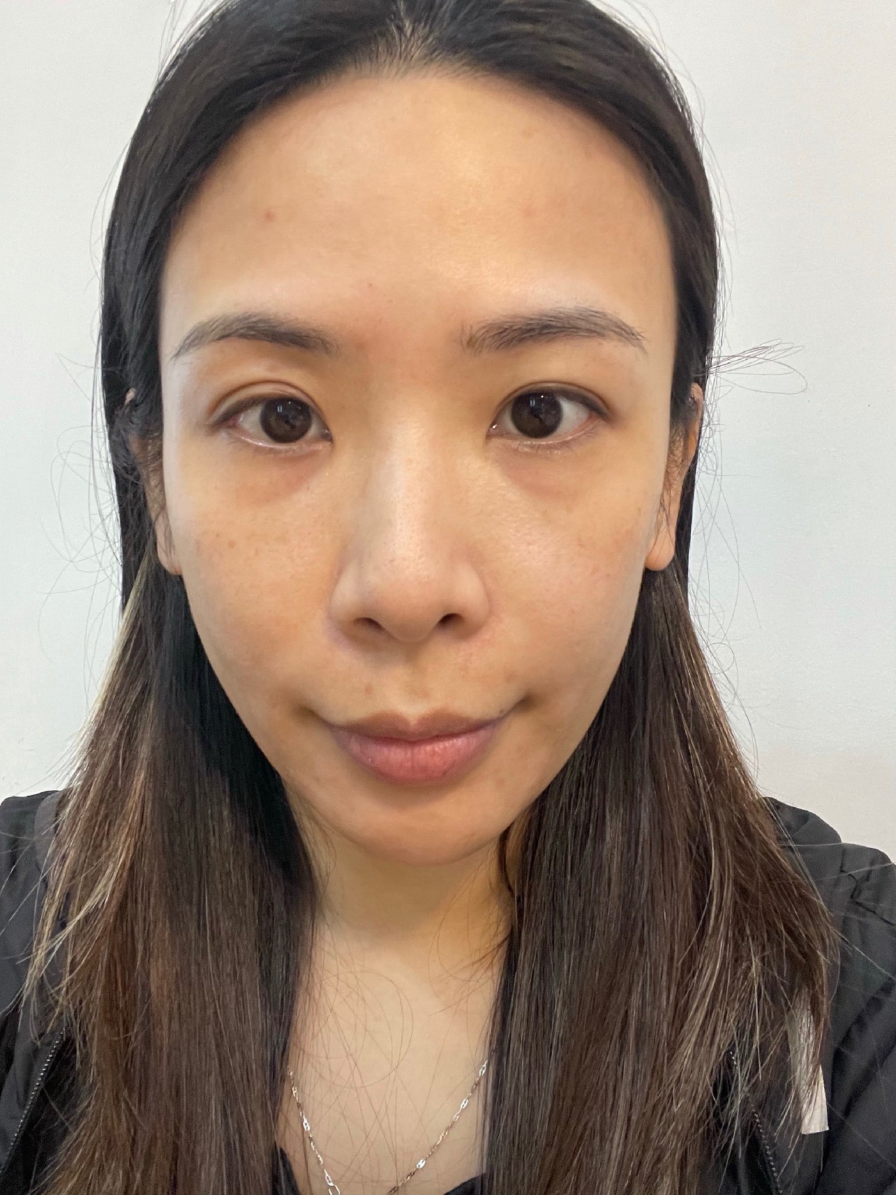 鼻基底凹陷是我一直比较烦恼的问题高度适中的鼻基底可以增加面部的