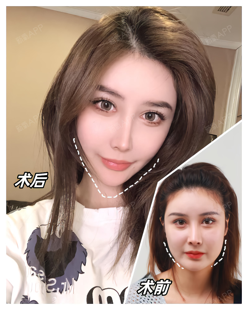 变美诉求:作为一个腮帮子大的大脸妹,打瘦脸是我一直_圈子-新氧美容