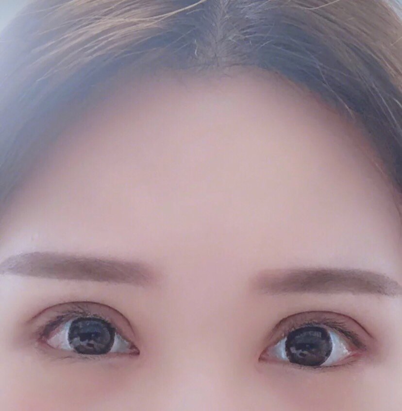 内双的人做完双眼皮的梗贴了两年双眼皮贴因为脂肪和赘_圈子-新氧美容