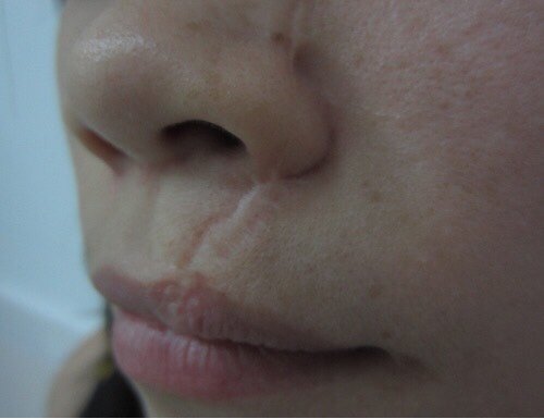 我是之前嘴巴受伤导致的疤痕,后面没注意,嘴巴上面有_圈子-新氧美容