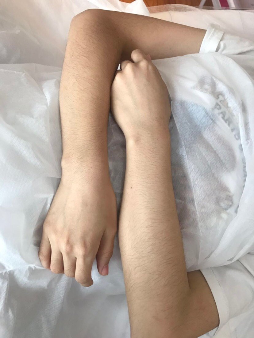 来脱了手毛,感觉很神奇,一下子就完事了!不错,美女_圈子-新氧美容整形