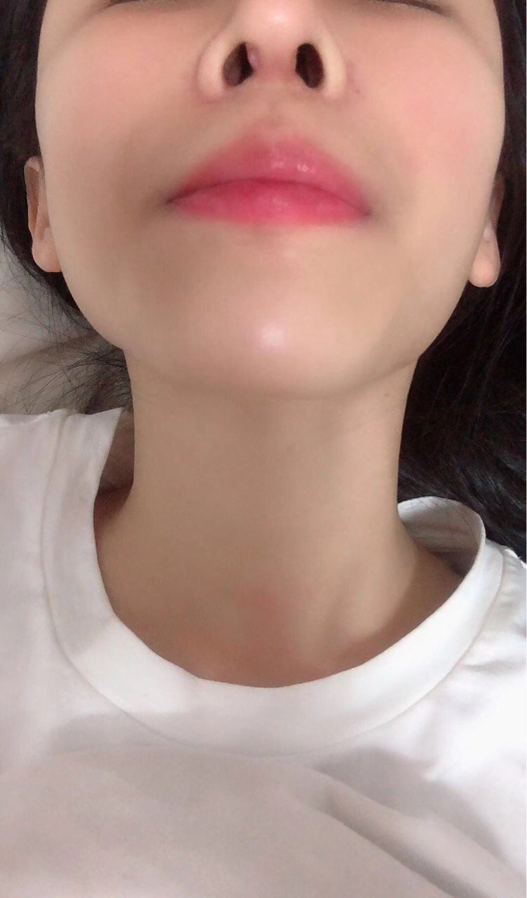 鼻子做了25天发现鼻子往左歪鼻孔也是一个大一个小假_圈子-新氧美容