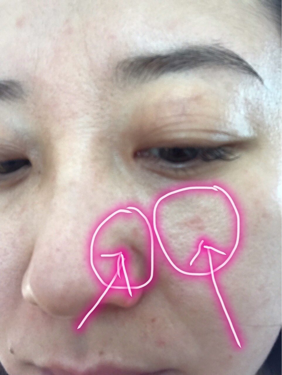 不知道为什么打完水光补水后左脸出现一块红斑挺大的左边鼻翼出现一个