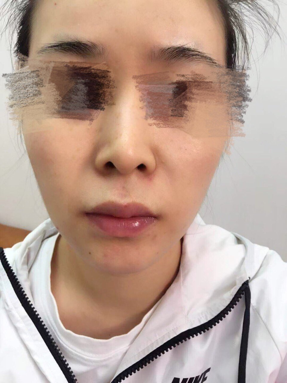 人中缩短这个手术我也是纠结了很久,因为害怕留疤一直_圈子-新氧美容