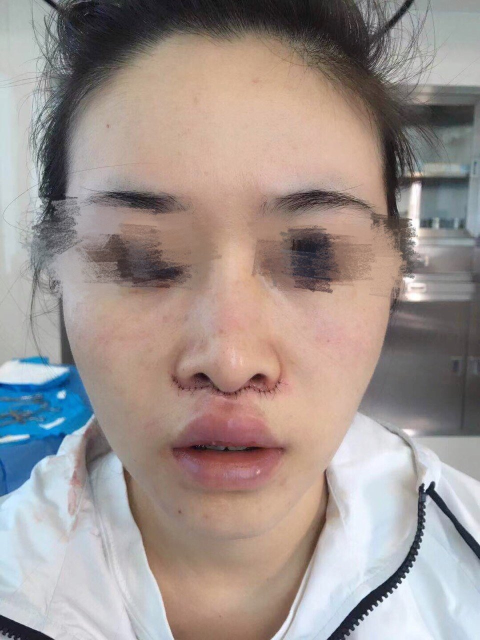 人中缩短这个手术我也是纠结了很久,因为害怕留疤一直_圈子-新氧美容