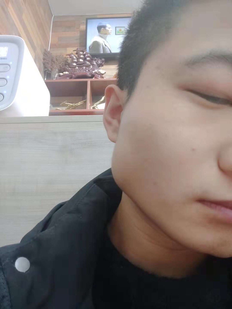 今天第四天咬肌肿的像是咬了个核桃一样.