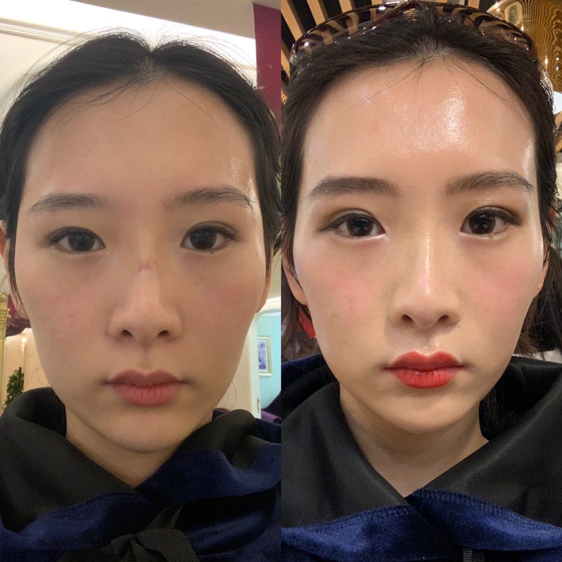 一张是效果稳定期和术前对比照.看来两针不够啊!