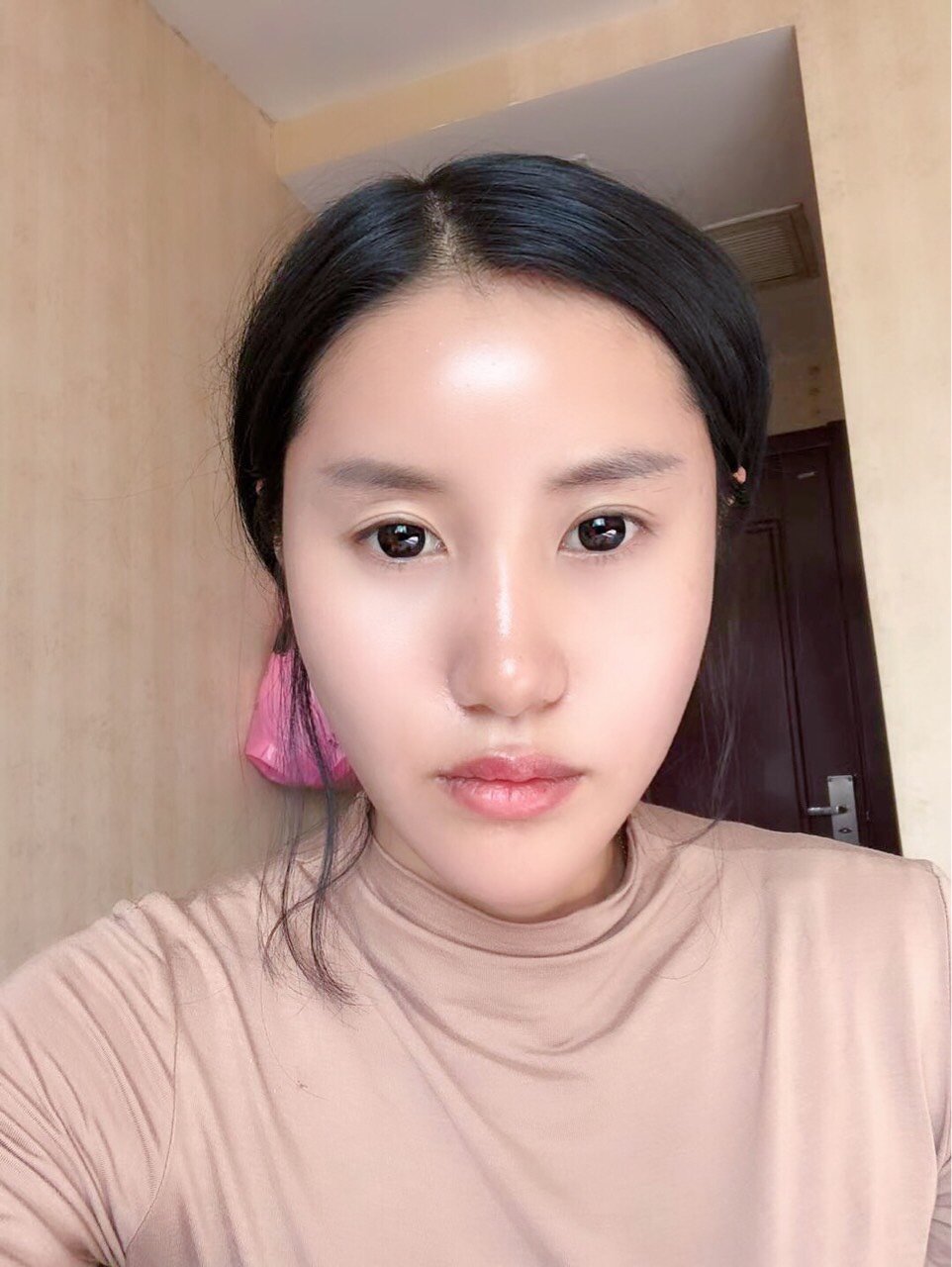 做完面部脂肪填充已经半个多月了,现在脸上脂肪很自然_圈子-新氧美容