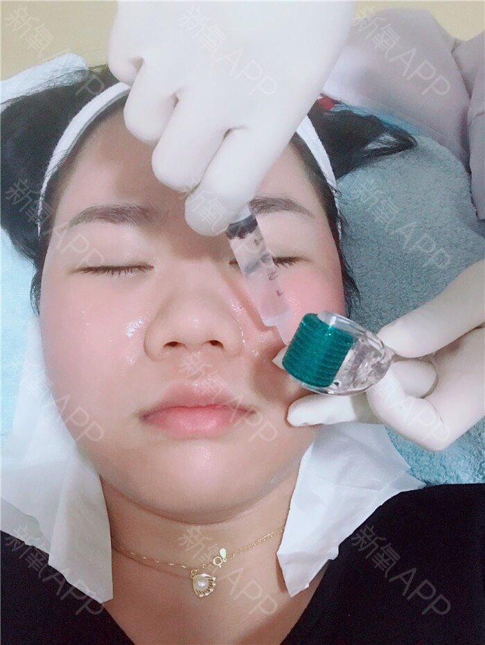 做了微针肤色提亮了很多,炒鸡开心,微针操作比较方便_圈子-新氧美容