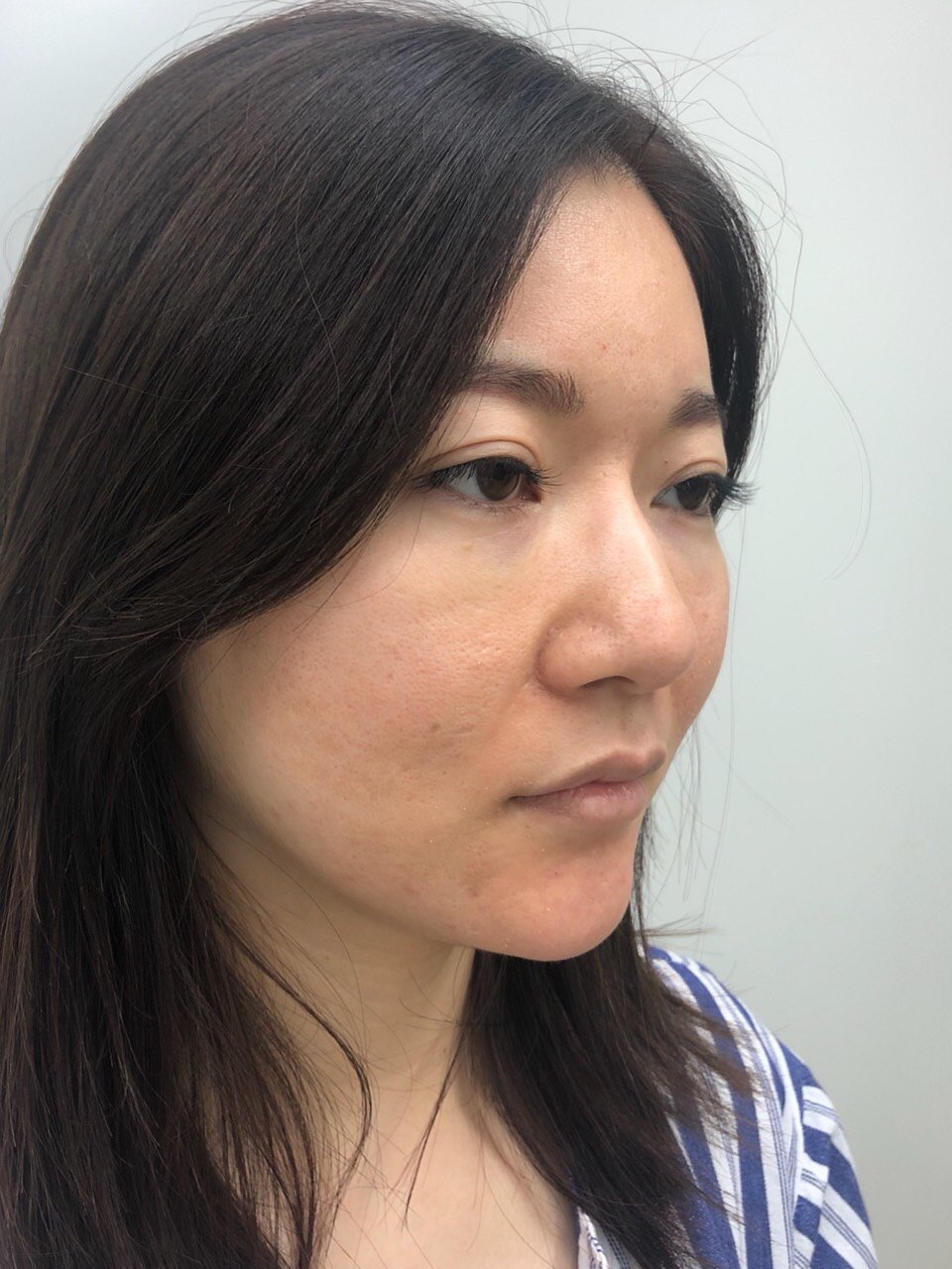 担心还要取,想做全肋,又担心全肋软骨容易弯曲,山根以前打过玻尿酸