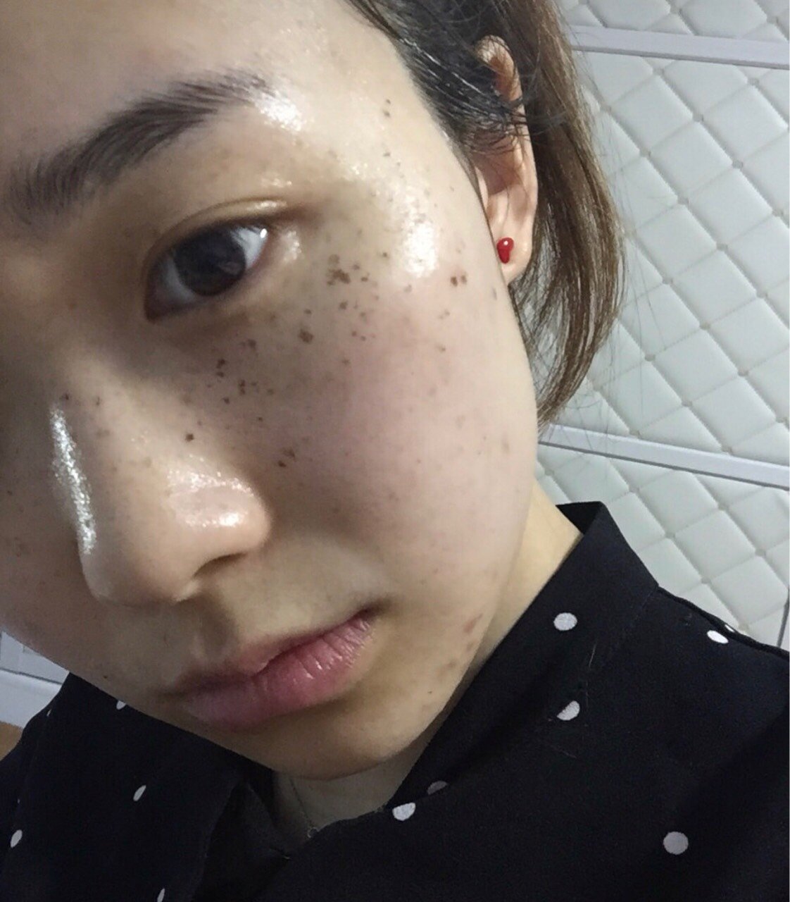 做一次的效果很明显呢,图1是做手术前的雀斑状况