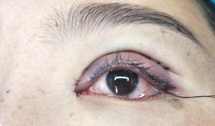 现在看了以我眼睛的小小程度,做个双眼皮和内眼角是改变不了多少的