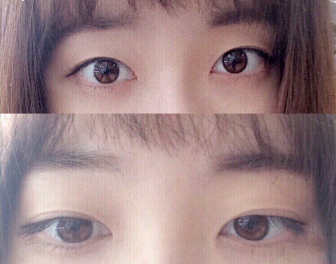 从小都是小内双,只有眯着眼从下面往上看才能看见褶子_圈子-新氧美容