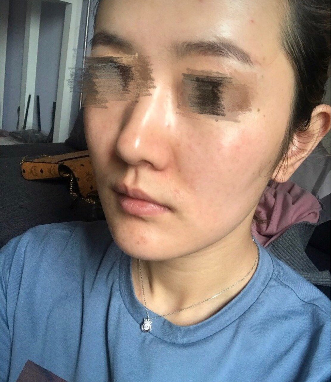 毛孔大,肤色暗沉不均,爱长痘痘,t区超级爱出油,夏天简直是大油田.