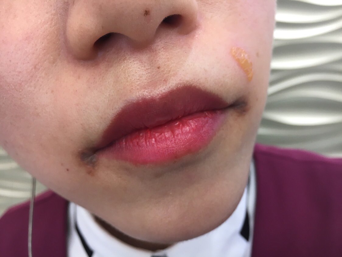 脱个唇毛给我烫成这样,告诉我慢慢恢复,刚开始还说我_圈子-新氧美容