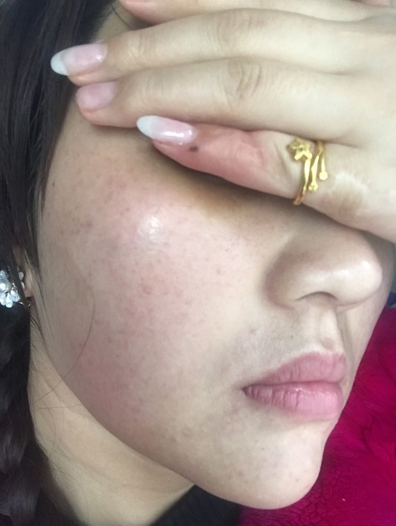 回来看看脸颊上针眼全部都淤青着.医生打水光深度2毫米,太狠了.