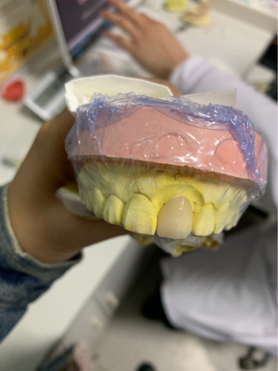 到处咨询牙齿怎么修复,后来别人推荐看了下新氧平台 别人的贴子,最