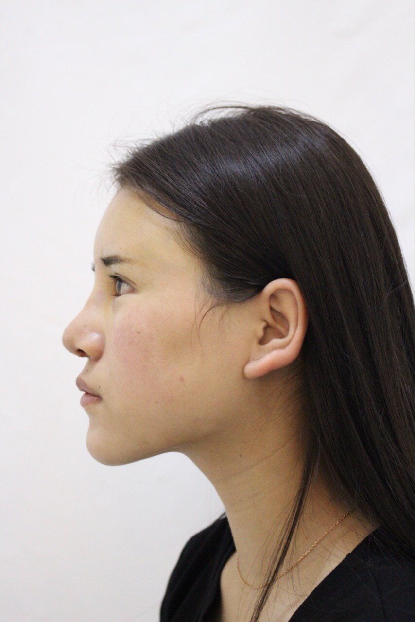 鼻子打了3年的玻尿酸,导致变的有点宽,侧面还好,正_圈子-新氧美容整形