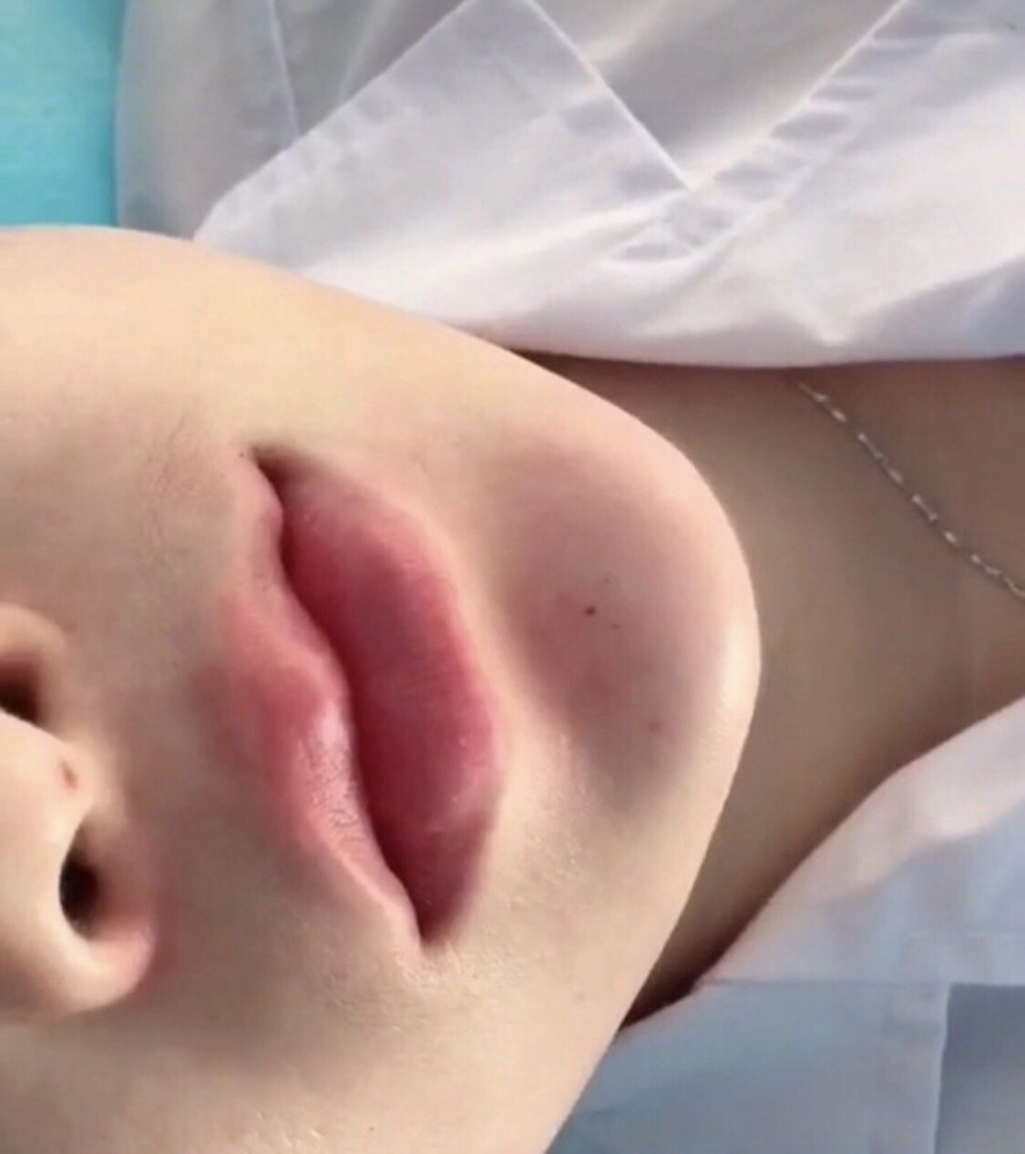 下巴补针,打的蛮自然的喜欢,环境也ok,又打了嘴巴,用了瑞蓝,她们家瑞