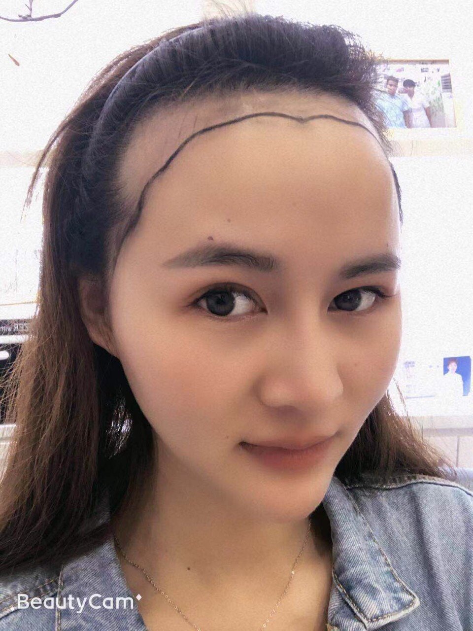 大脑门儿的问题困扰我很久了,想做发际线让脸变小 家人都支持我,力求