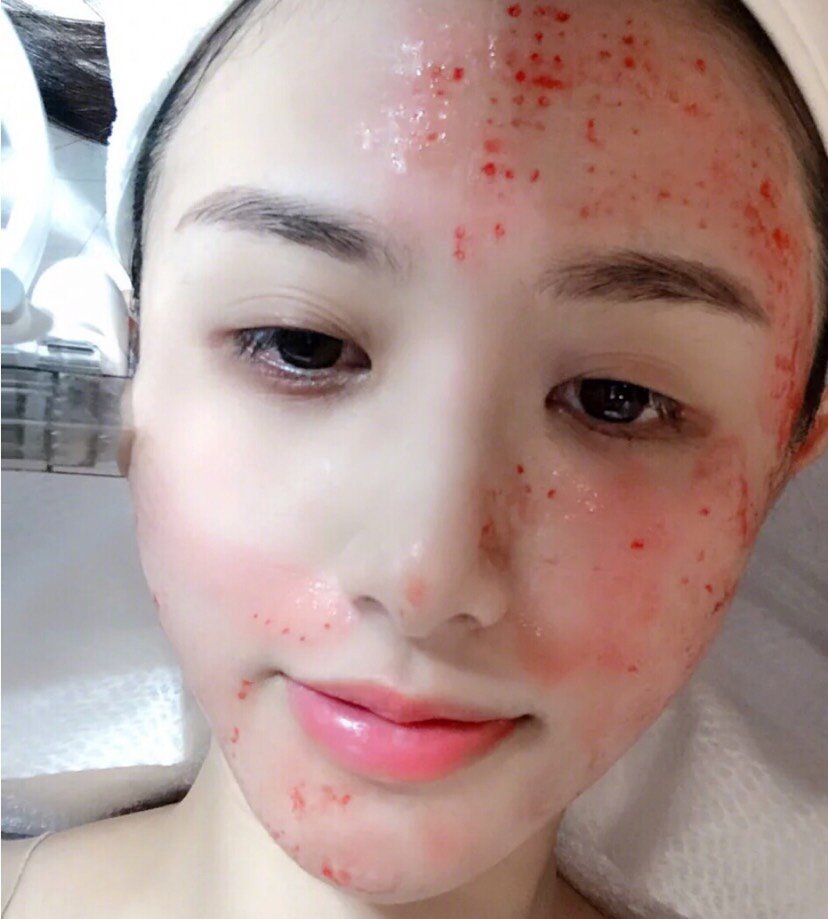 做完水光补水有段时间了,效果挺好的,脸上明显水润了好_圈子-新氧美容