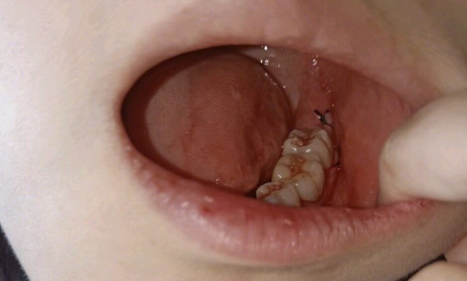 连智齿都蛀了果断拔掉我其他蛀的牙齿可怎么办诶