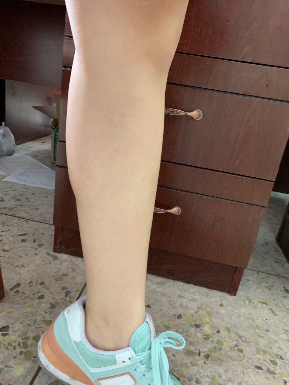 注射第88天左腿几乎恢复到以前的样子了摸着是硬的右_圈子-新氧美容整