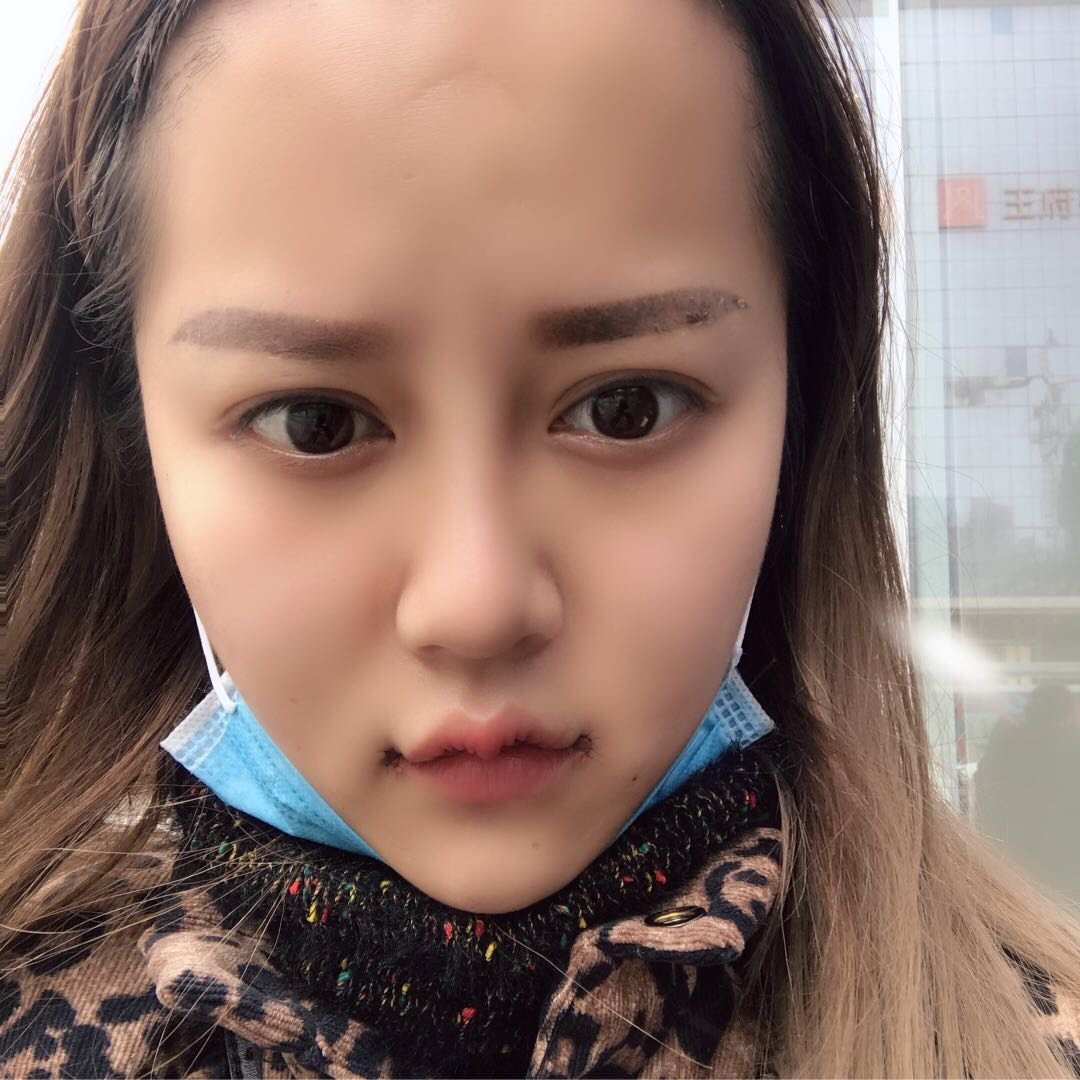 【m唇手术】【m嘟嘟唇】【特价】【m微笑唇】唇峰唇珠成型 嘴角上扬