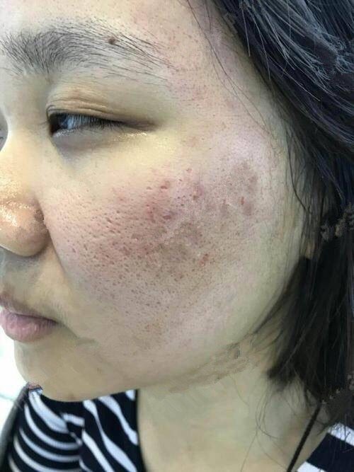 脸上痘印真的……一言难尽,我也是朋友推荐过来的,他_圈子-新氧美容