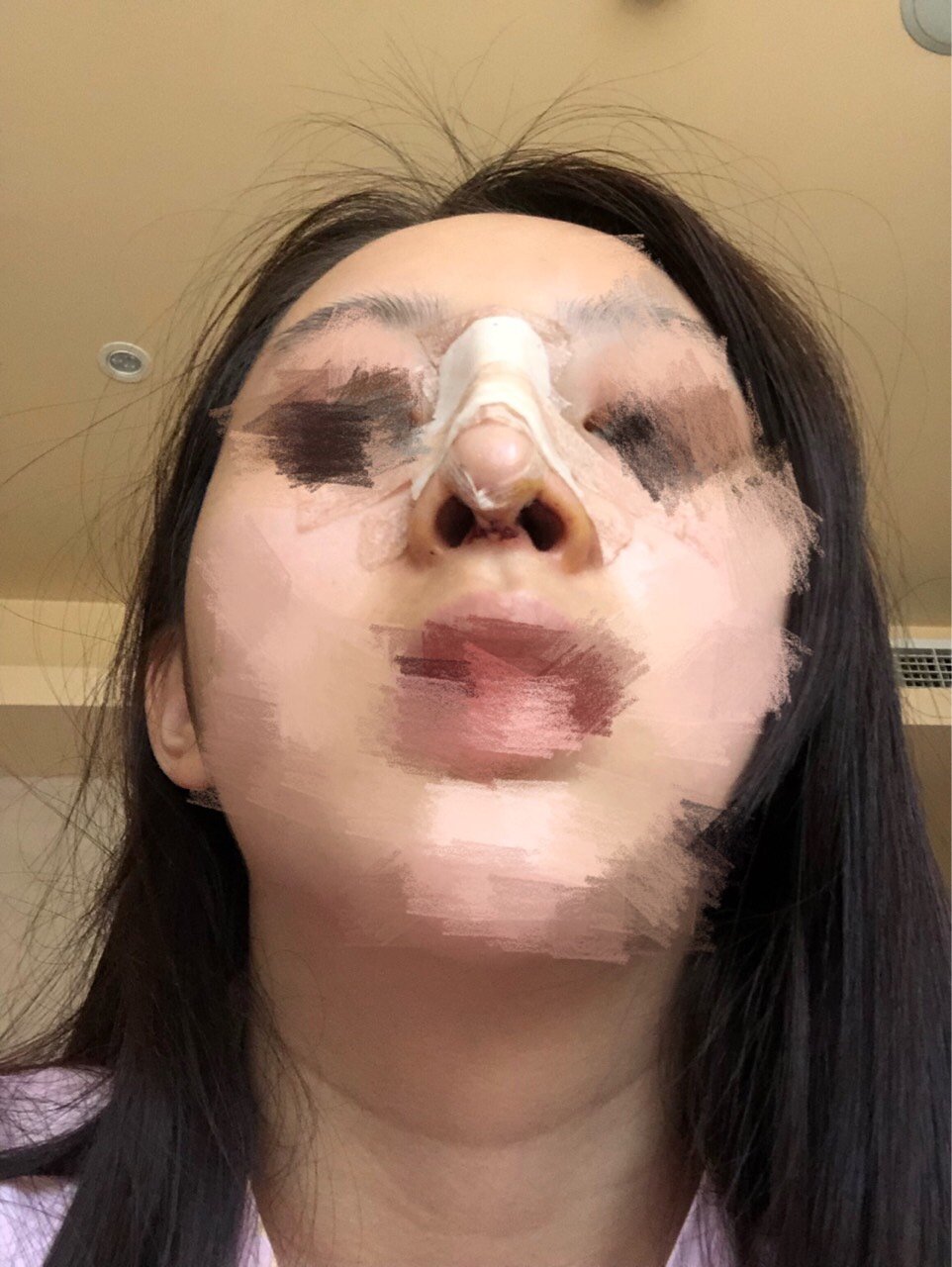 鼻子一直处于歪的状态