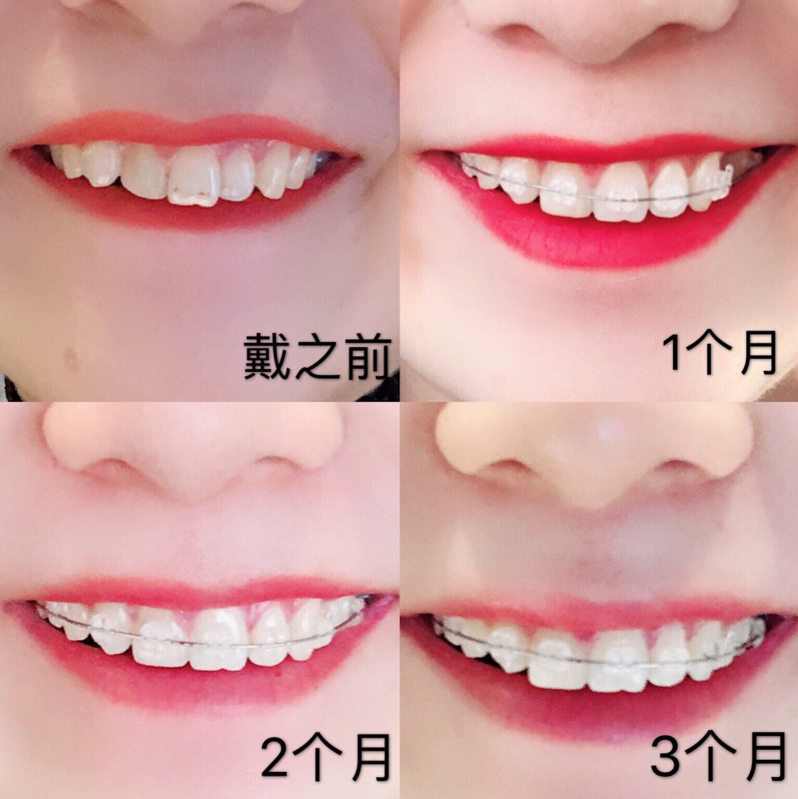 【隐形托槽矫正【牙齿矫正】陶瓷半隐形托槽矫正改善嘴凸牙列不齐