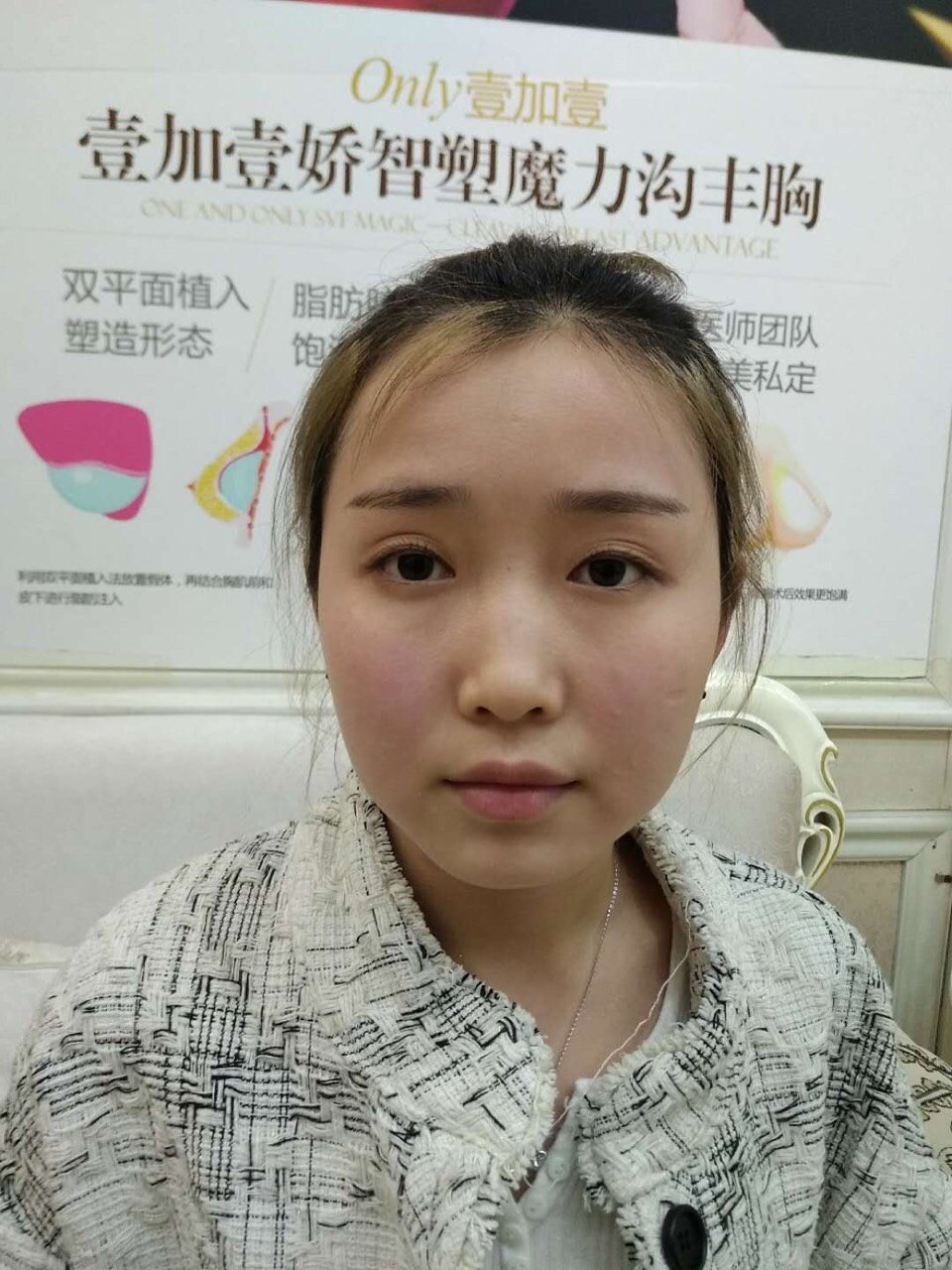 2年前在老家做的埋线双眼皮(照片最后一张图),之后_圈子-新氧美容整形