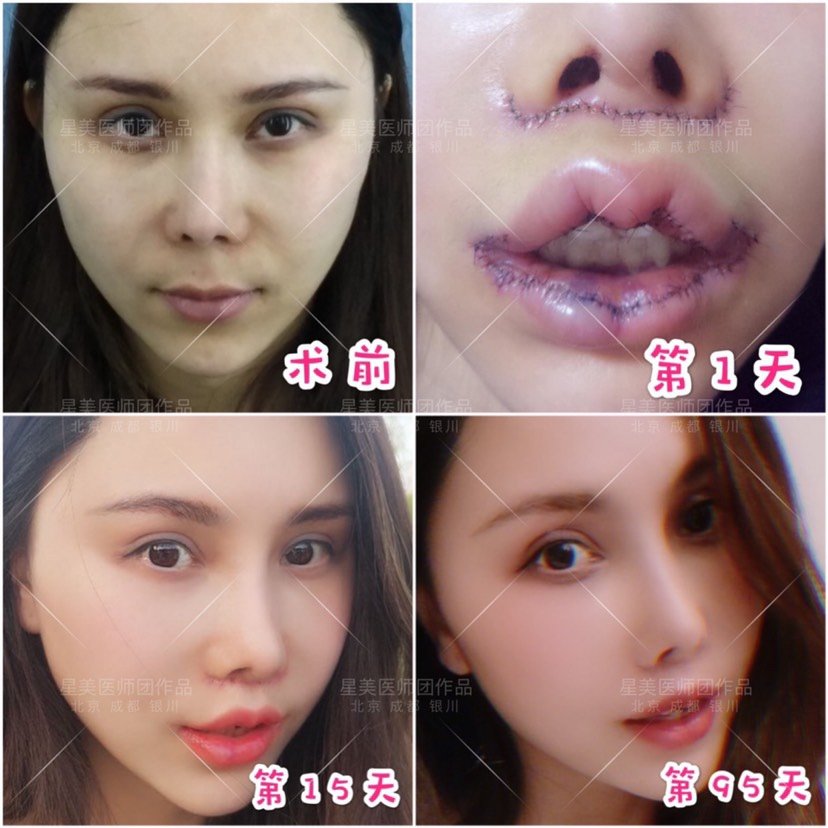 急求人中缩短有什么手术方式呢?哪种疤_新氧美容整形