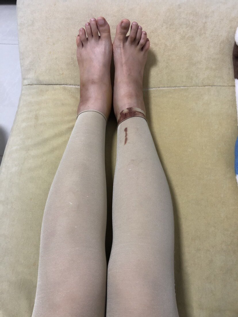 我之前在本地医院做过一次小腿吸脂,当时那个医生只给_圈子-新氧美容