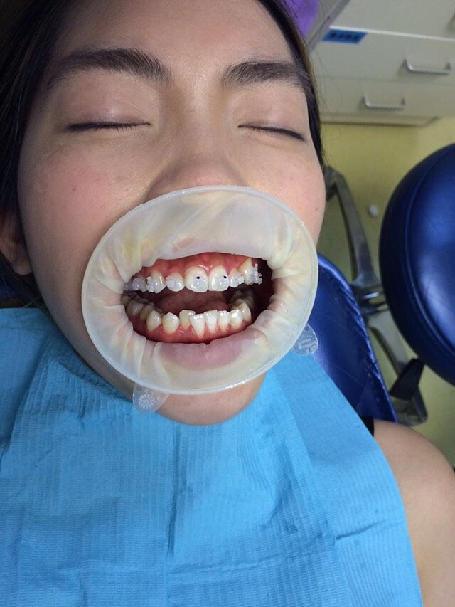 戴牙套的过程还是比较舒适的不会痛主要是嘴张开有点累不过这都不算
