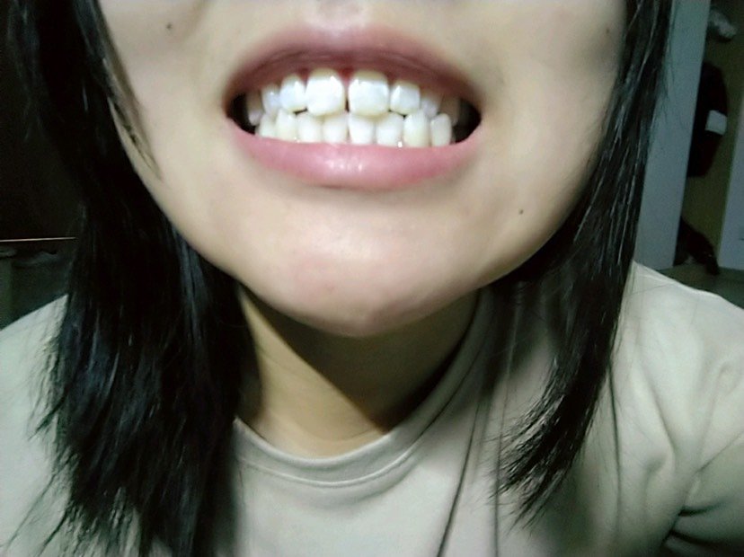 很早之前就因为门牙缝太大不敢大笑,但是上学的时候看带牙套好贵,等