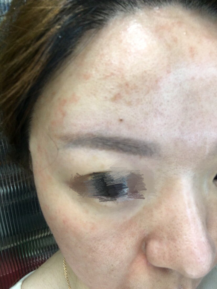 还没做白瓷娃娃,敷上麻药后就红,烫,过敏了…整个脸_圈子-新氧美容