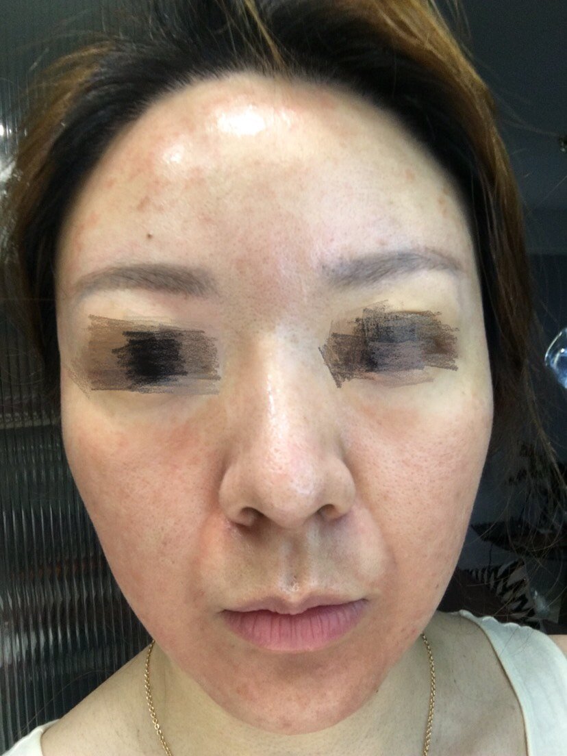 还没做白瓷娃娃,敷上麻药后就红,烫,过敏了…整个脸_圈子-新氧美容
