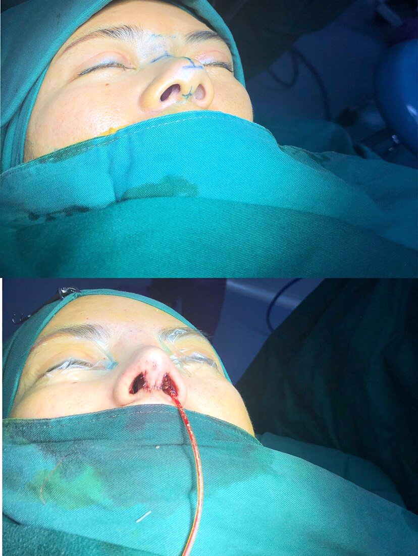 【手术缩鼻翼】【鼻翼缩小】隐痕切口 鼻头缩小/肥鼻矫正/宽鼻矫正