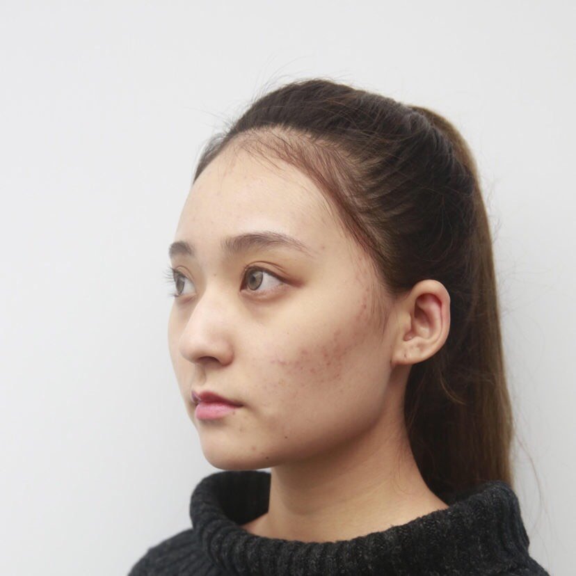 我们家人的脸型都比较宽,就我一个例外颧弓宽,下颌角特别肥大还外翻