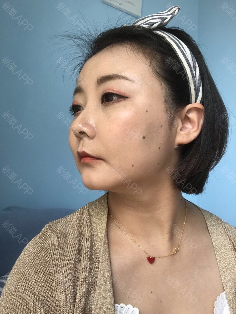 颧骨手术60天,现在的面部恢复的很好已经看不出手术_圈子-新氧美容