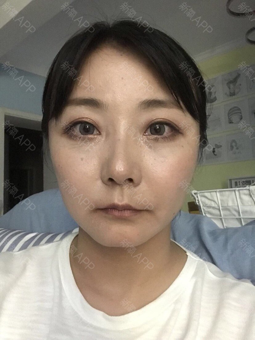 颧骨手术60天,现在的面部恢复的很好已经看不出手术_圈子-新氧美容