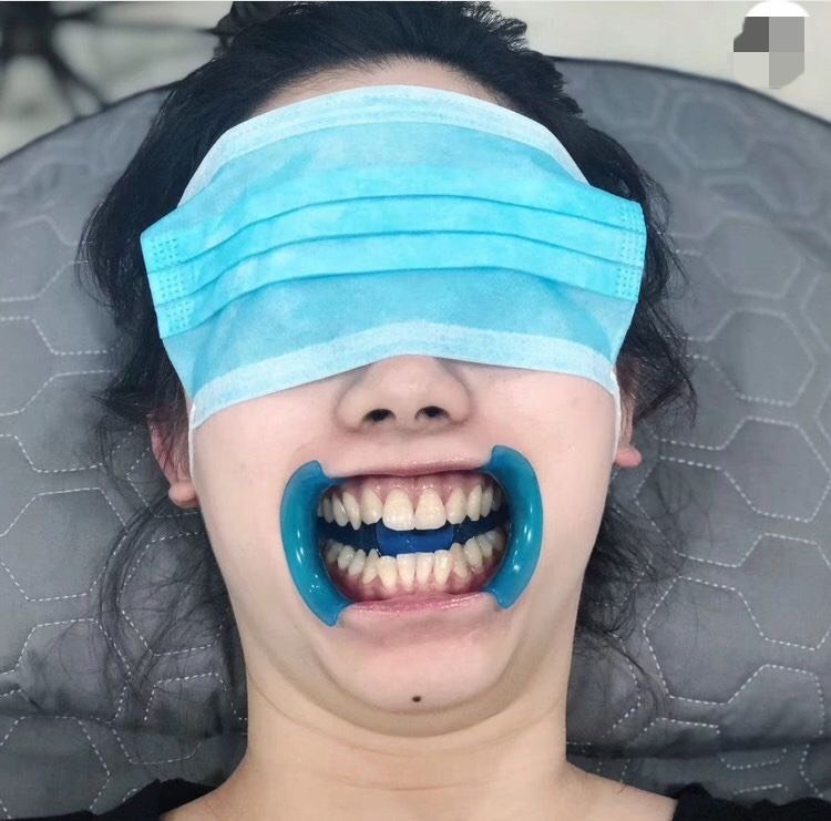 我觉得,这个才是真正的美牙,全瓷牙齿贴面唉,我觉得_圈子-新氧美容