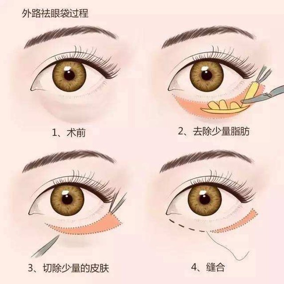 而眼睑下至则是在下眼线部位 如图