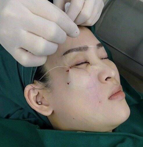 【埋线提升】ppdo线雕提拉台湾专家线雕手法逆龄抗衰 打造小v脸 首根