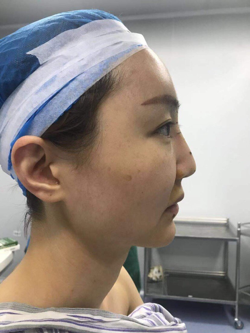 硅胶鼻修复肋软骨鼻部多项肋软骨填充鼻基底